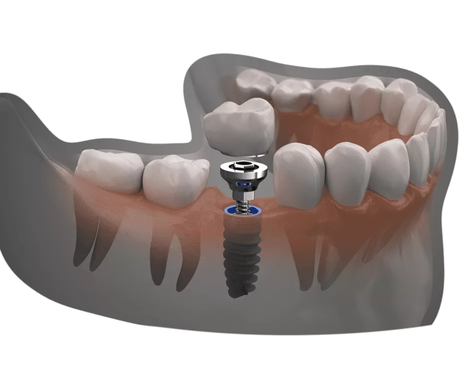 a guide to finding the right dentist for your dental implant in turkey