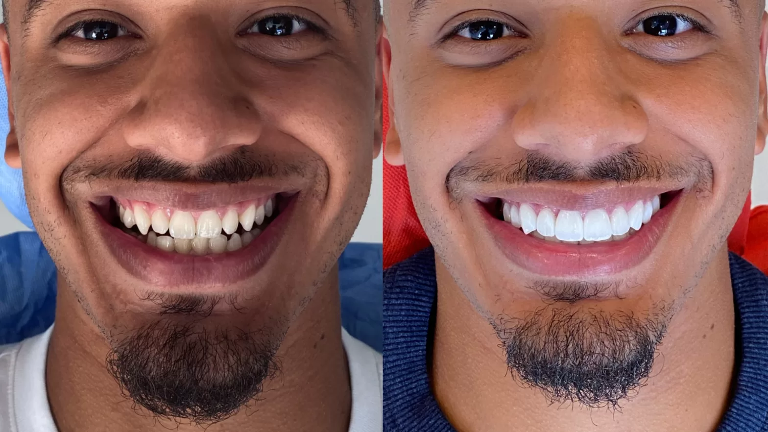 achieve perfection with a hollywood smile in turkey