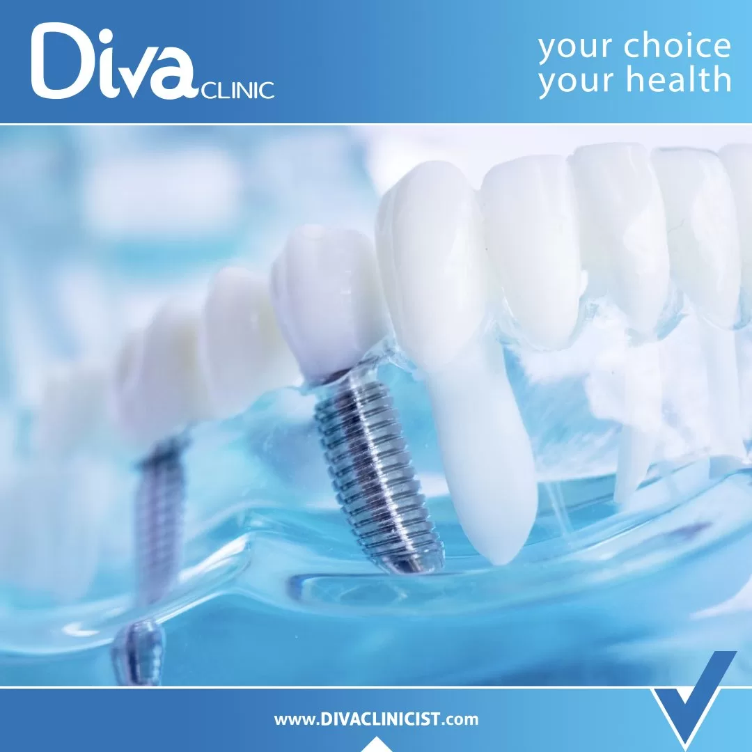an overview of dental implant procedures in turkey