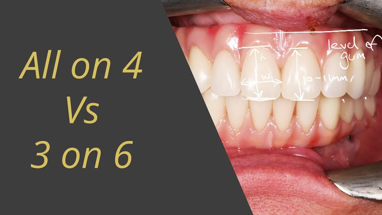 benefits of allonfour dental implants