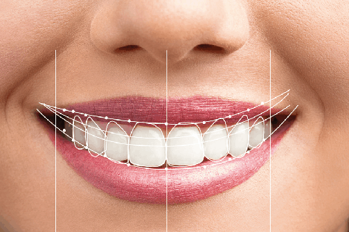 brighten your smile with a hollywood smile makeover