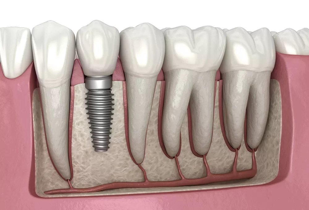 comparing traditional and latest techniques of dental implants