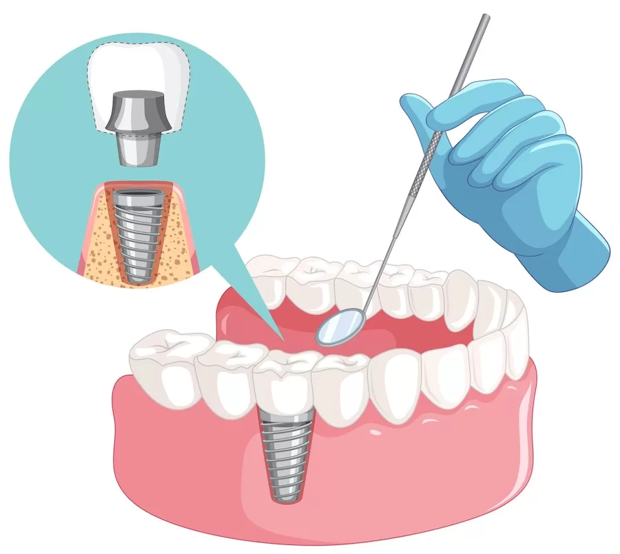 dental implant awareness month