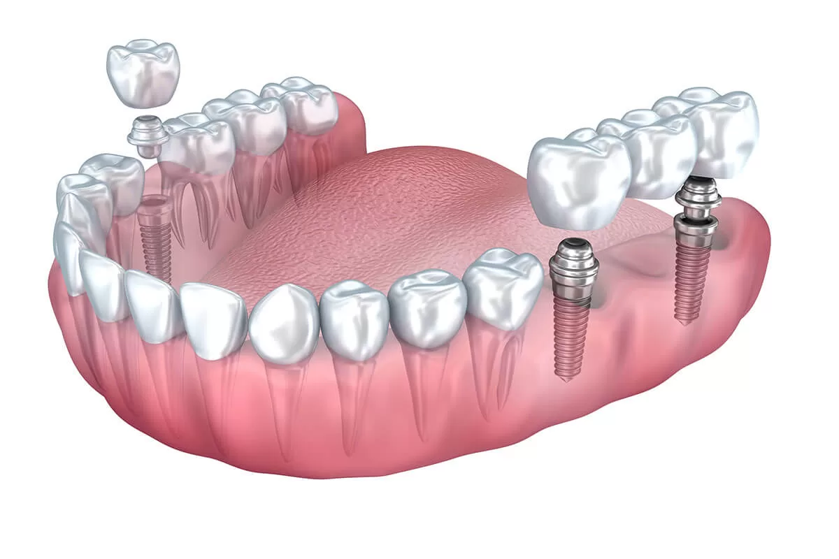 dental implant benefits to help you make the right decision