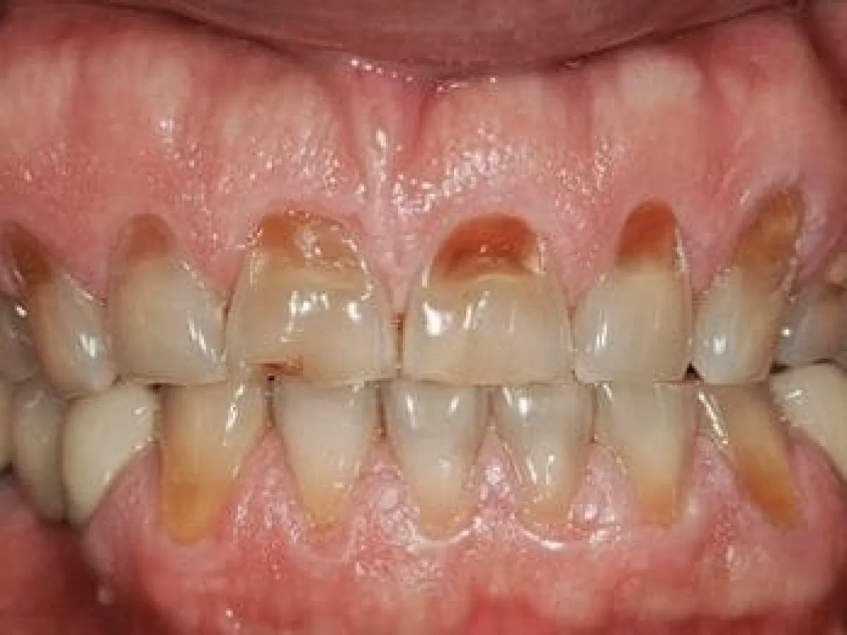 do braces make the roots of your teeth shorter