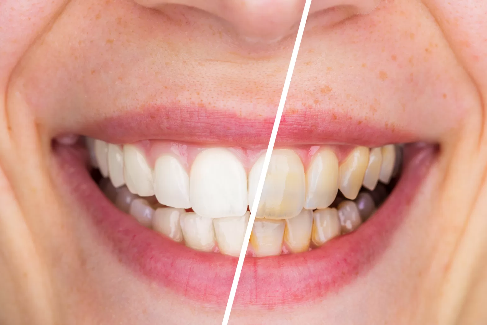 dos and donts after teeth whitening