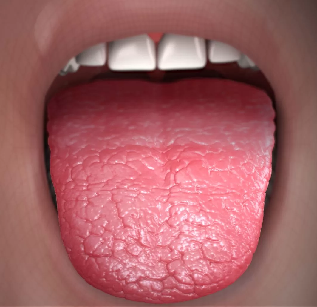 effects of a dry mouth on your oral health