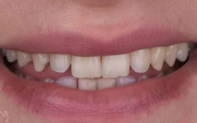 enhancing smiles with cosmetic dentistry in istanbul