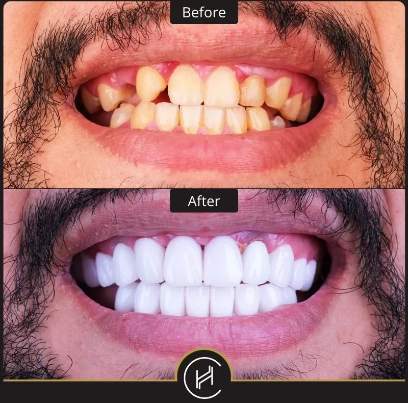 experience lifetime confidence with a hollywood smile in istanbul