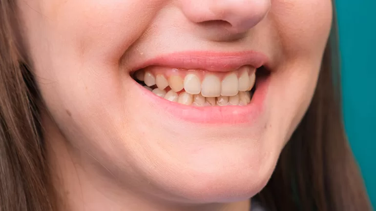 exploring the benefits of a hollywood smile