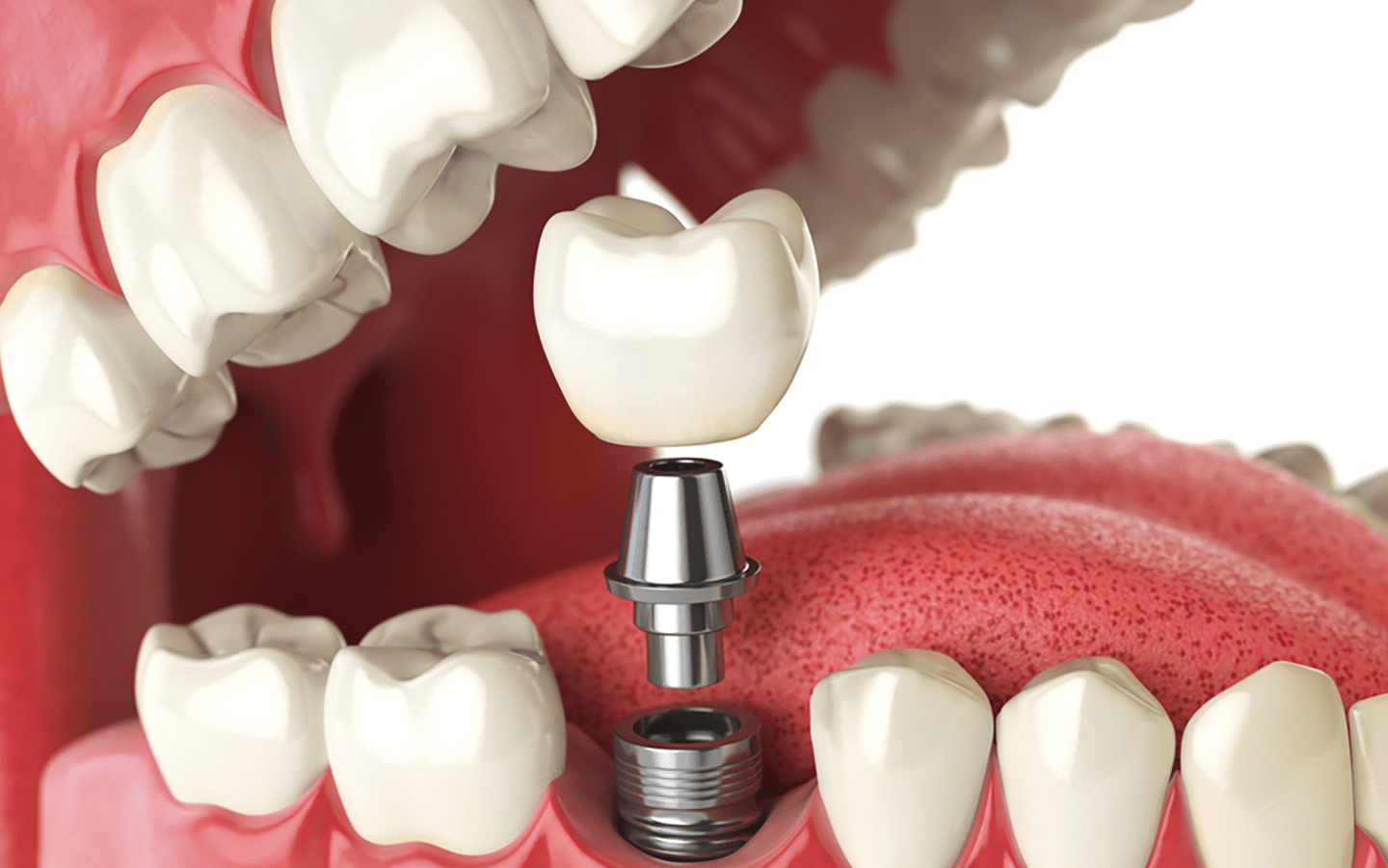 exploring the benefits of dental implants