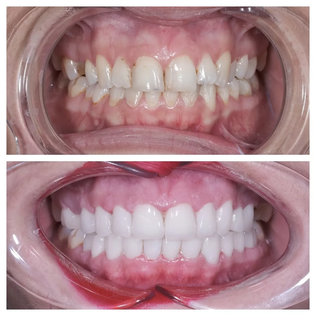 hollywood smile in turkey achieving a stunning smile makeover