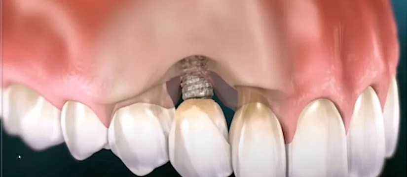 maximizing the success of dental implants