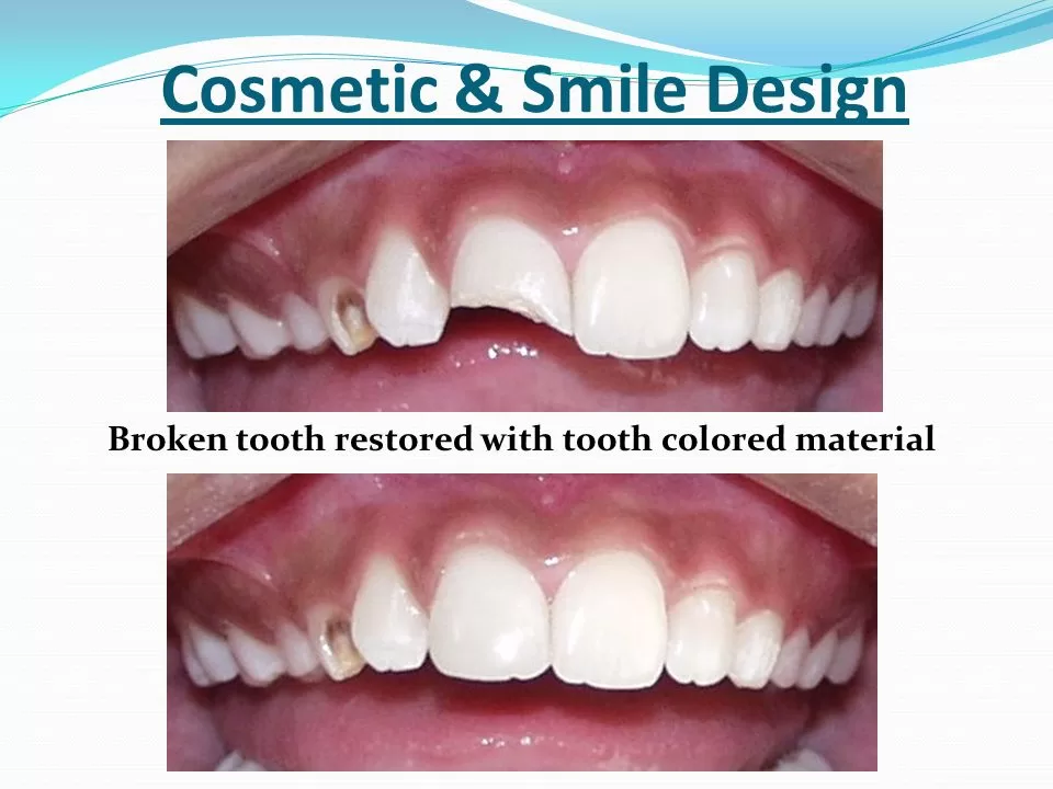revealing the magic behind dental smile design