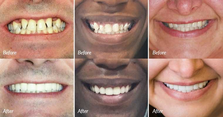 teeth whitening techniques to create your own hollywood smile