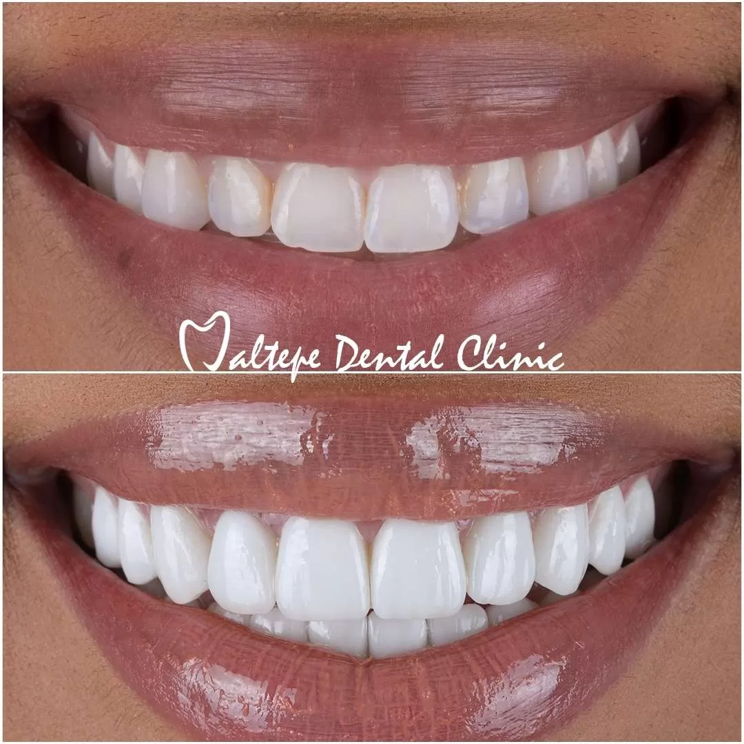 the advantages of professional teeth whitening for a hollywood smile in turkey