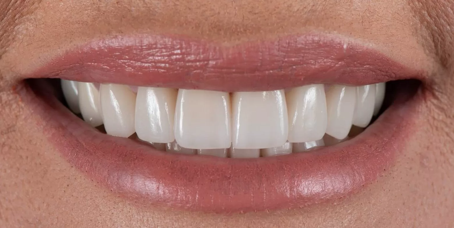the benefits of a hollywood smile how achieving a perfect smile can boost your confidence