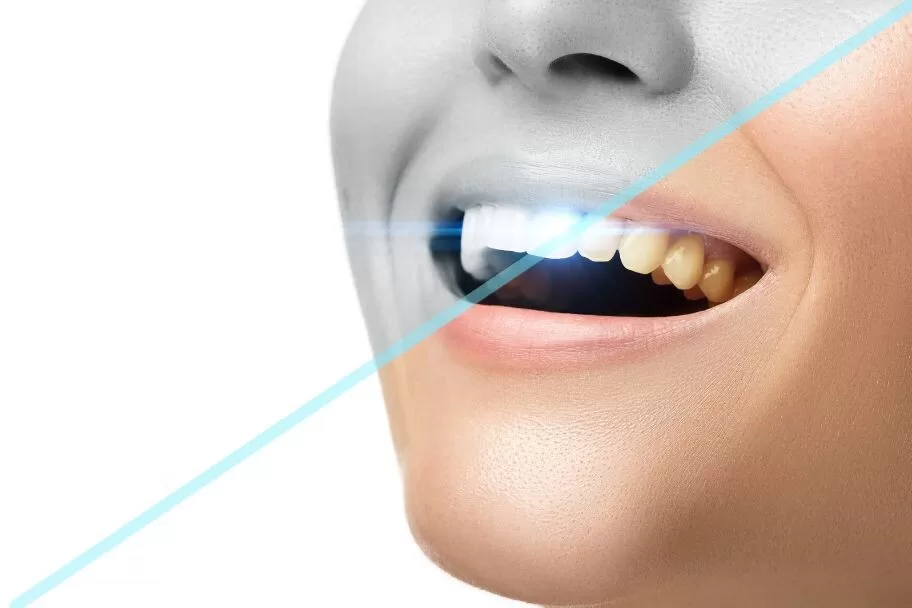the benefits of teeth whitening how a brighter smile can improve your life