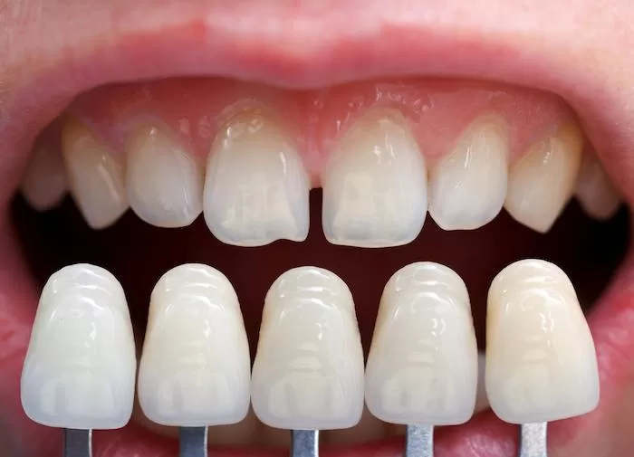 the impact of a hollywood smile on selfconfidence 3