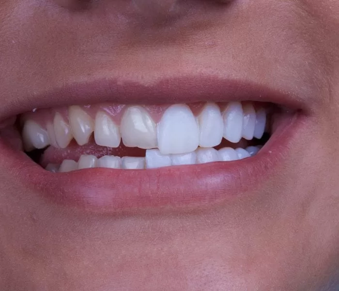 transform your smile with clinic effects veneers treatment 5