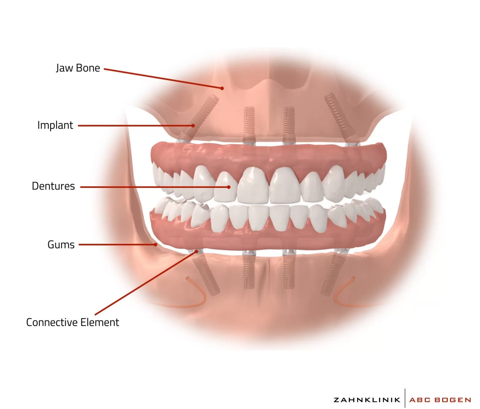 understanding the allonfour dental implant procedure