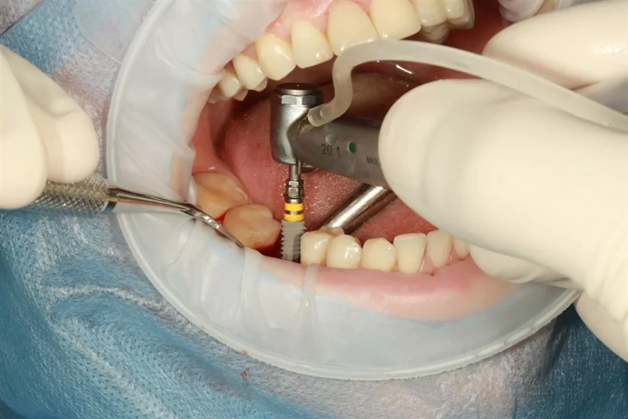 understanding the basics of dental implant surgery