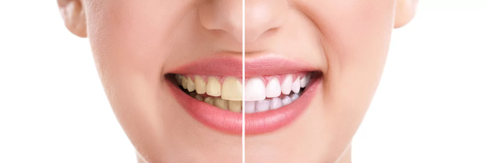 what you should know about teeth whitening understanding the positive and negative effects of teeth whitening treatments