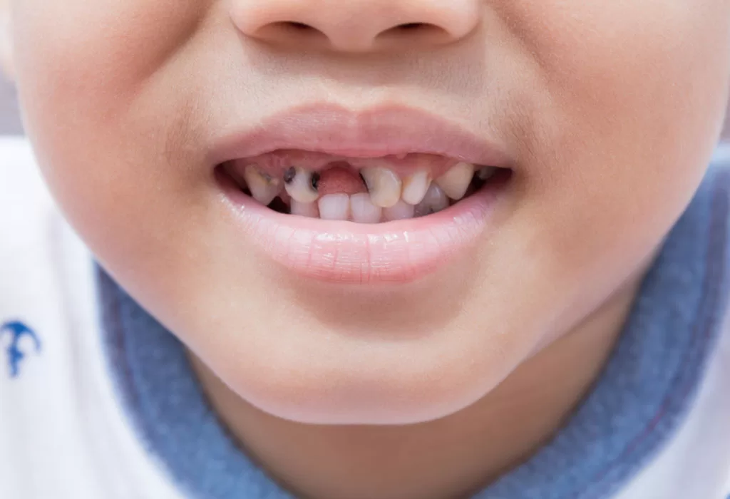 why tooth decay is a problem for kids