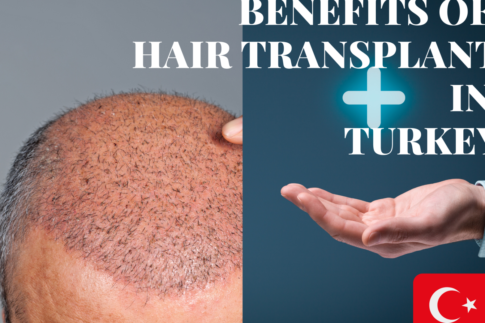 advantages of hair transplant in turkey