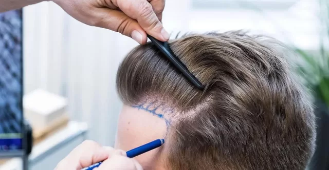 hair transplant with dhi technique cliniceffect